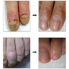Herbal Nail Treatment Sterilization Liquid Foot Care