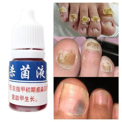 Herbal Nail Treatment Sterilization Liquid Foot Care