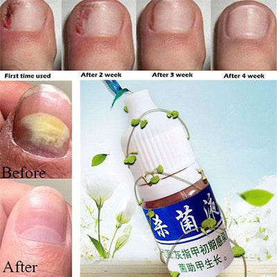 Herbal Nail Treatment Sterilization Liquid Foot Care