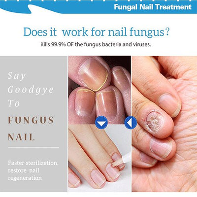 Nail Repair Treatment Liquid Fungus Remover Protective