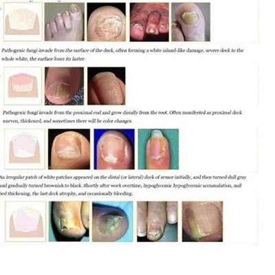 Herbal Nail Treatment Sterilization Liquid Foot Care