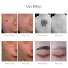 Skin Spots Removal Laser Pen